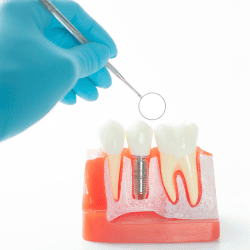 Los Mejores Dentistas en Mexico para Implantes Dentales